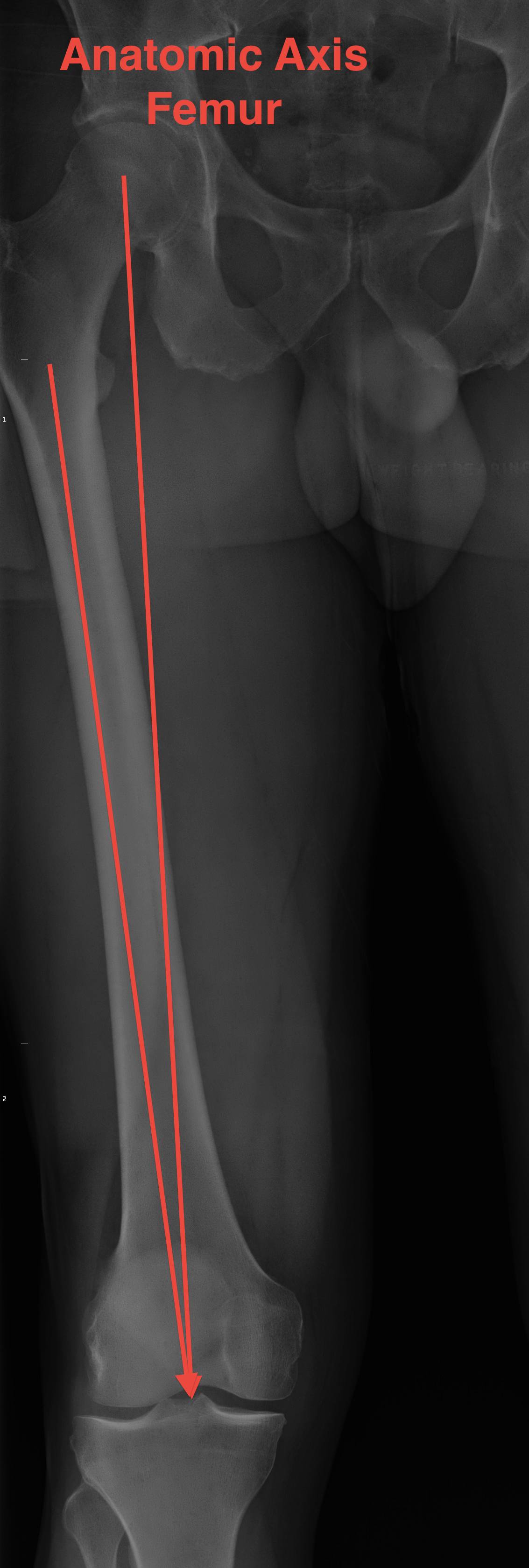 Anatomic Axis Femur